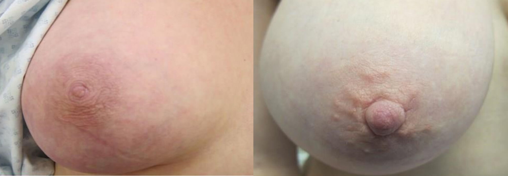 Female Inverted Nipples 75
