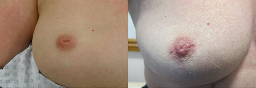 Get Rid Of Puffy Nipples Without Surgery 69