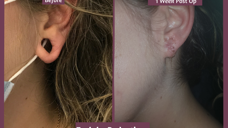 1 week post enlarged earring hole reduction