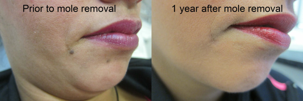 Mole removal of two moles on chin
