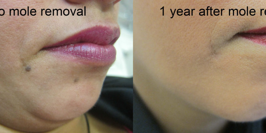 Mole Removal NYC   Wall Street Dermatology