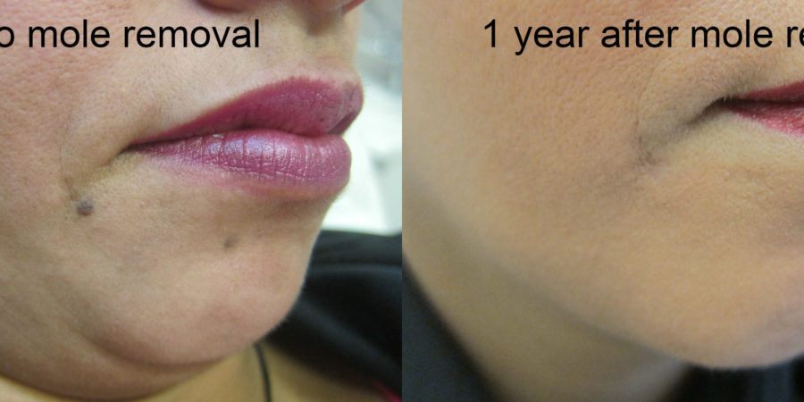 It Is The Side Of Excessive Mole Removal Rarely Seen, But That's Why Is Required
