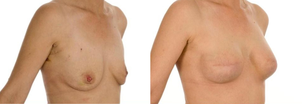 Breast reconstruction uk picture 415