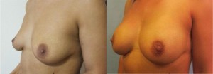 breast augmentation with low profile round implants