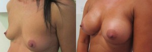 supernatural breast augmentation