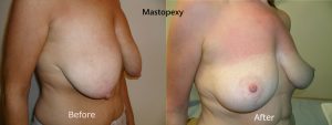 Mastopexy