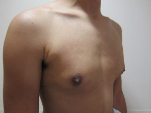 Mild Gynecomastia