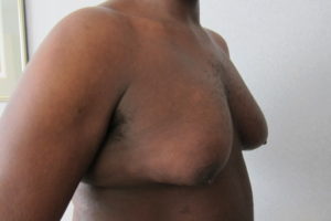 Severe Gynecomastia