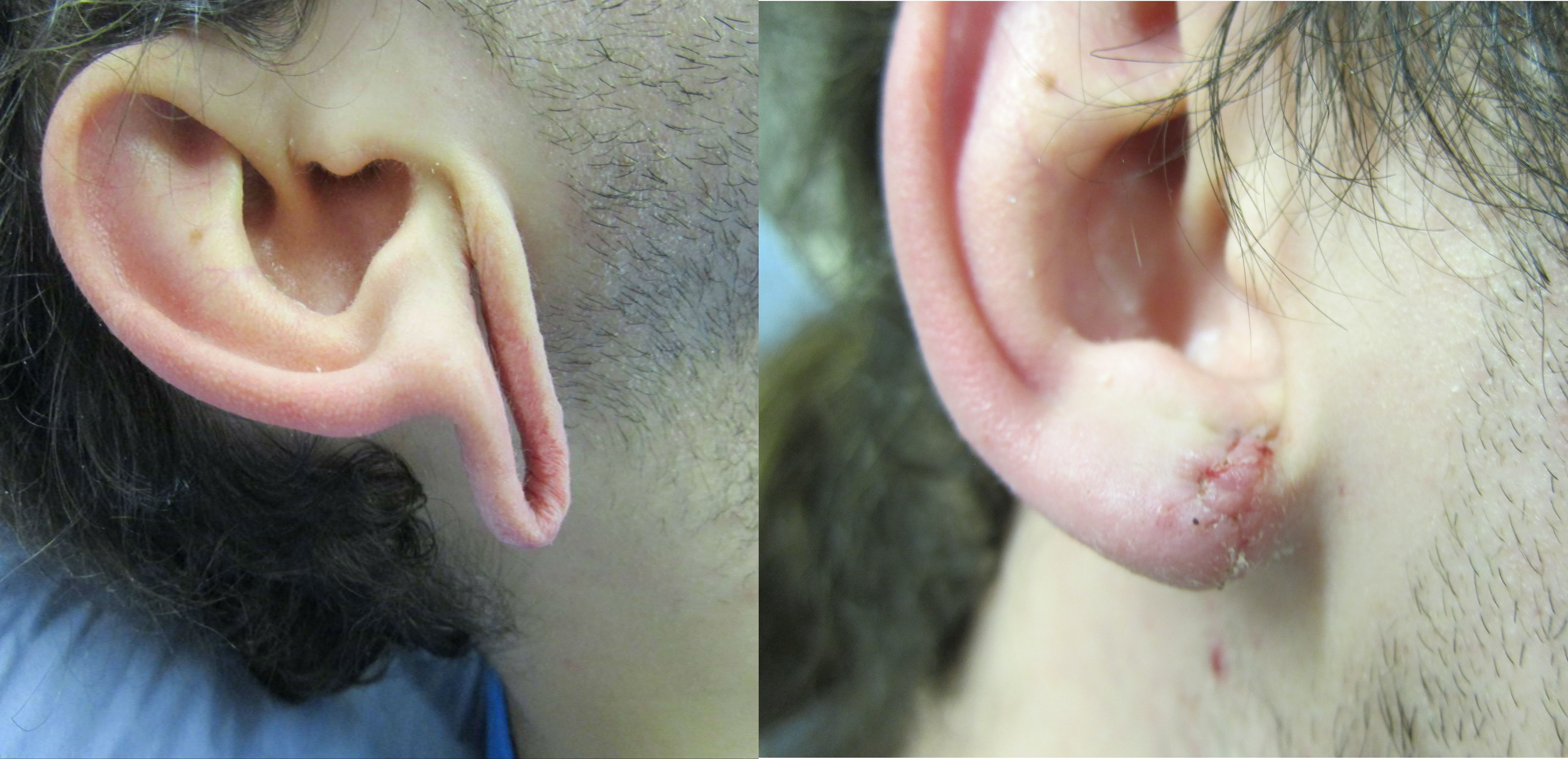 Earlobe Repair | Otoplasty (Earlobe repair): Otoplasty aims to reshape and  reposition the ears for a more balanced and symmetrical look. The Otoplasty  procedure is... | By South Florida Oral & Facial