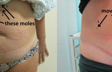 tummy tuck belly button surgery eat drink staiano plastic