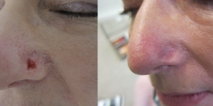 different-types-of-skin-cancer