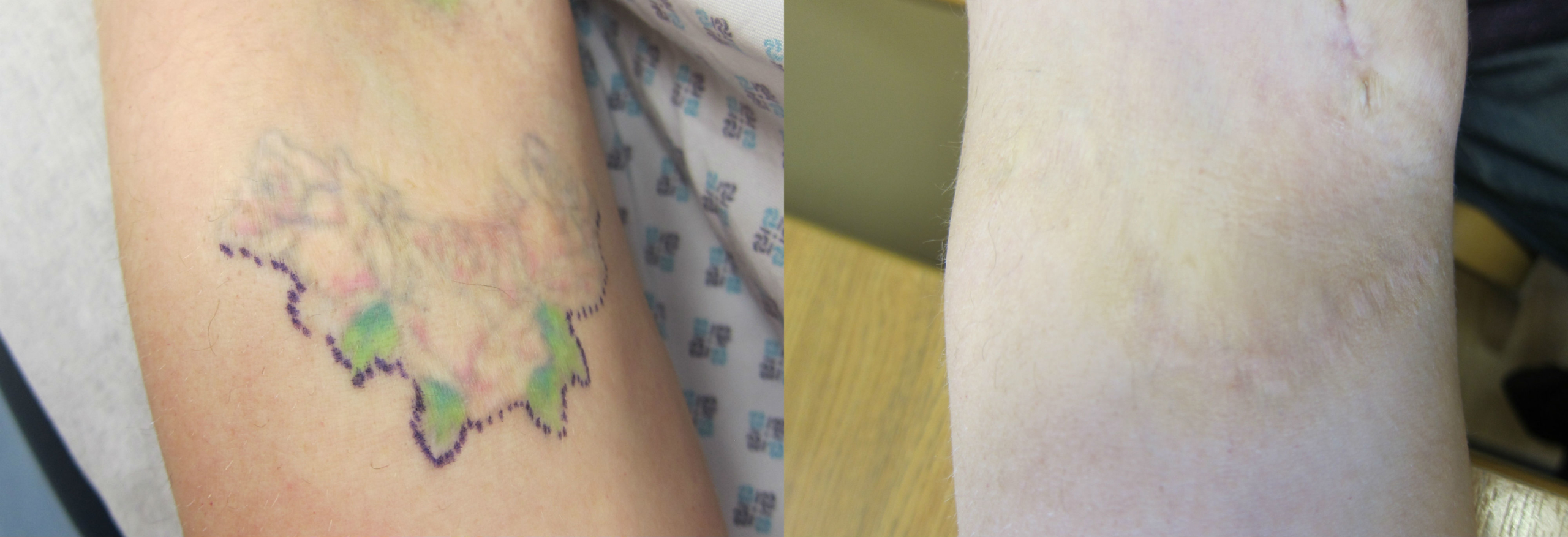 Tattoo Removal - Birmingham - Staiano Plastic Surgery