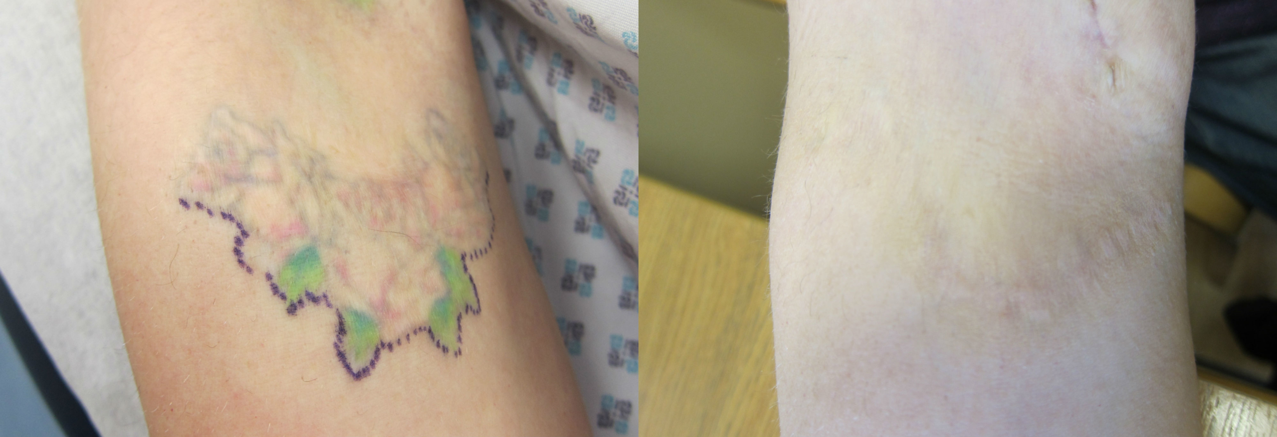 Laser Tattoo Removal  Abbys Beauty Secrets