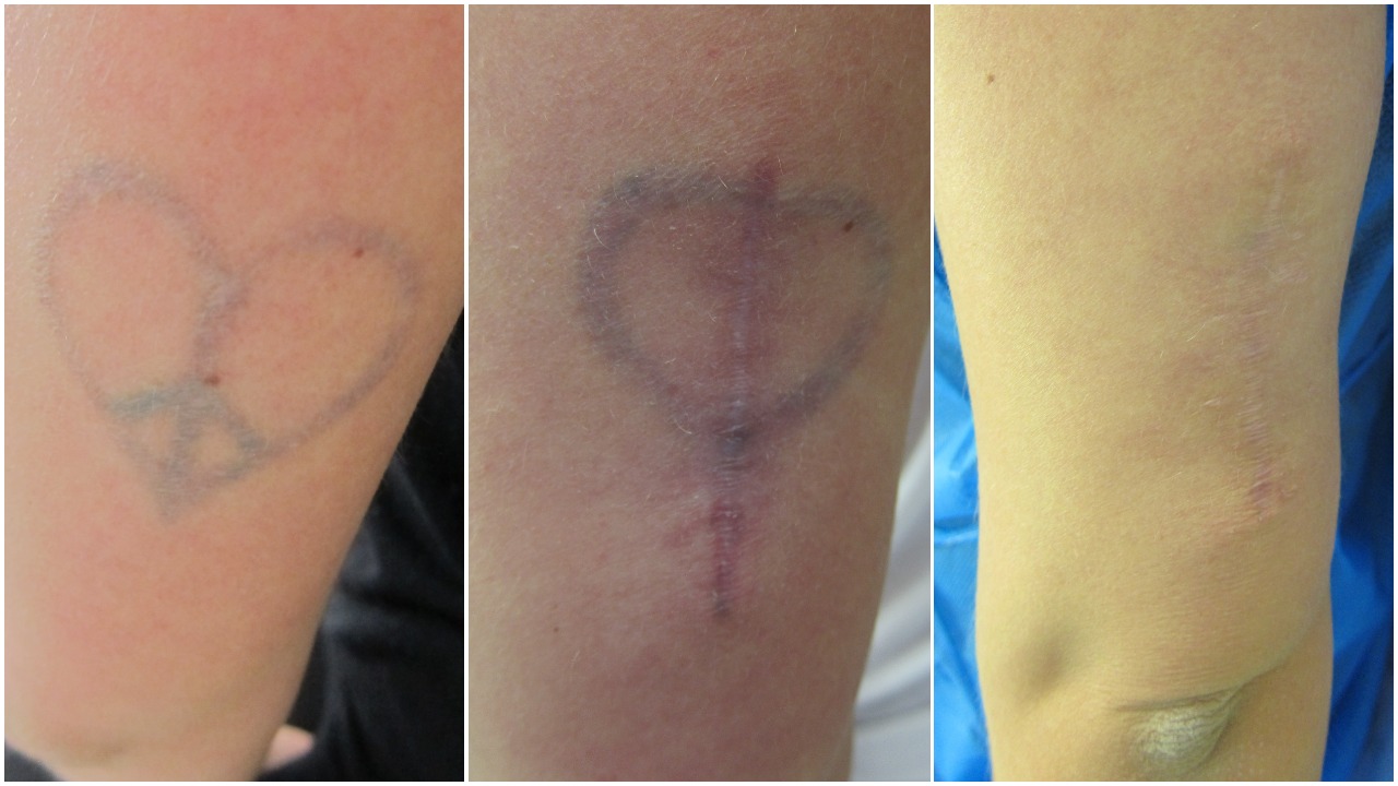Tattoo Removal - Birmingham - Staiano Plastic Surgery