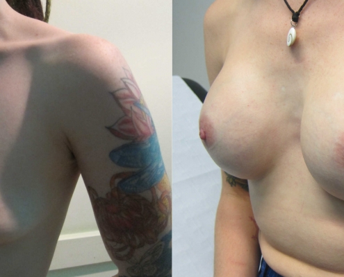 Before-and-After-285cc-moderate-profile