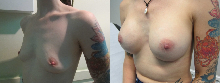 Before-and-After-285cc-moderate-profile