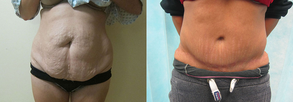 What happens to my belly button during a tummy tuck? - Staiano Plastic  Surgery