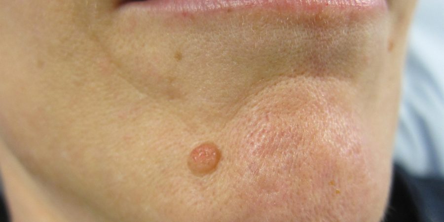 skin moles to worry about