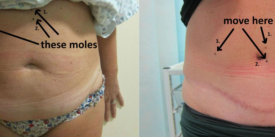 Abdominal Scarring Removed with Tummy Tuck