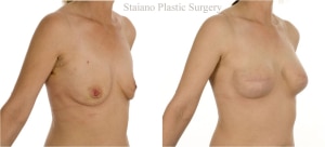Bilateral implant breast reconstruction with Allograft