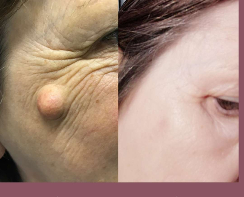 Cyst removal on cheek