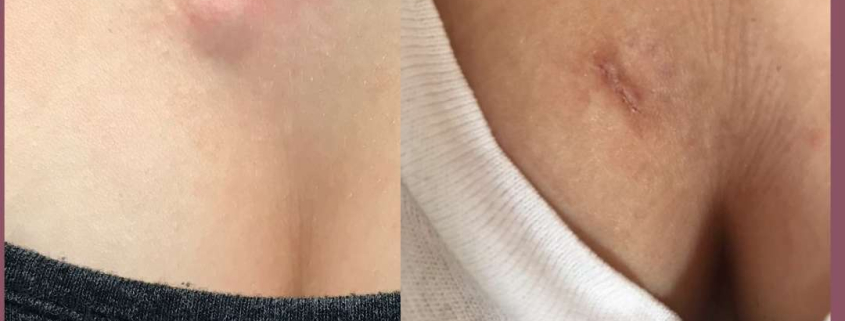 Cyst removal on cleavage