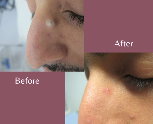 Cyst removal on nose