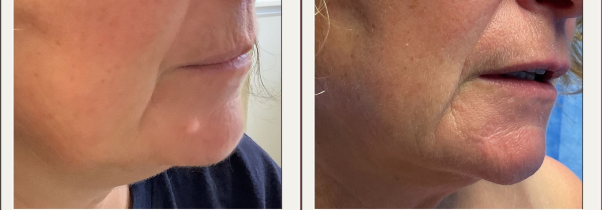 before and after mole removal on chin