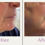 before and after mole removal on chin