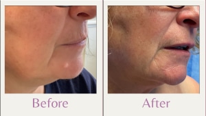 before and after mole removal on chin