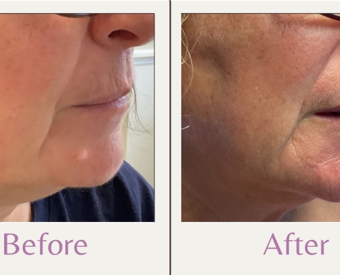 before and after mole removal on chin