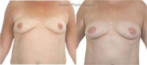 Double mastectomy and reconstruction with bilateral DIEP flaps