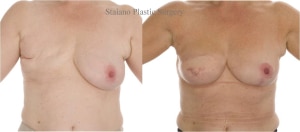 Extended latissimus dorsi flap and implant