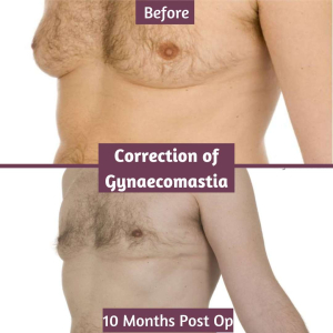 Gynaecomastia Correction