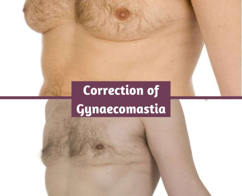 Gynaecomastia Correction