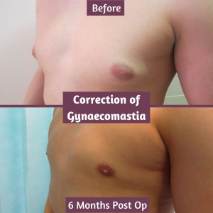 Gynaecomastia Correction