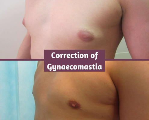 Gynaecomastia Correction