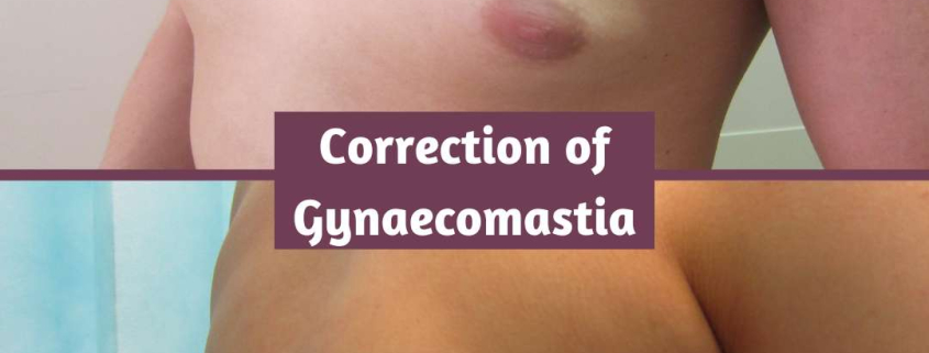 Gynaecomastia Correction