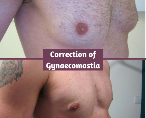 Gynaecomastia Correction