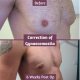 Gynaecomastia Correction