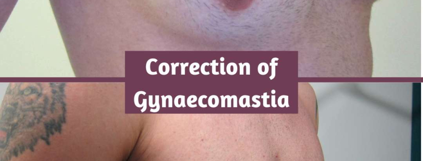 Gynaecomastia Correction