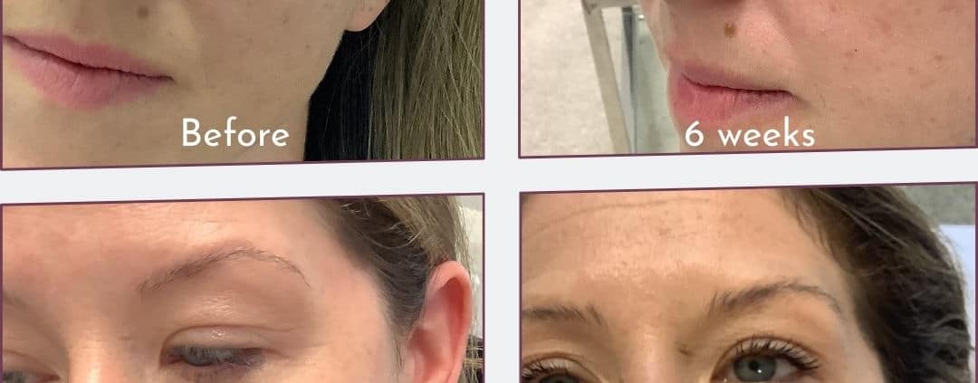 Mole on cheek - before and after up to 4 years