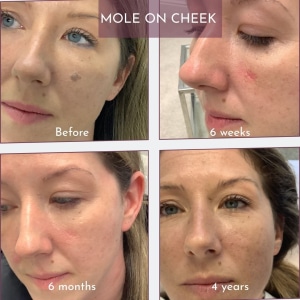 Mole on cheek - before and after up to 4 years