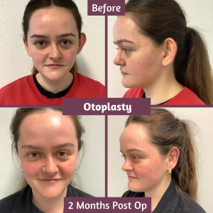 Before and After Otoplasty