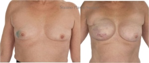 Right implant reconstruction