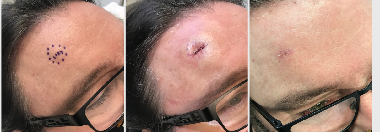 Sebaceous cyst on forehead at 1 week after