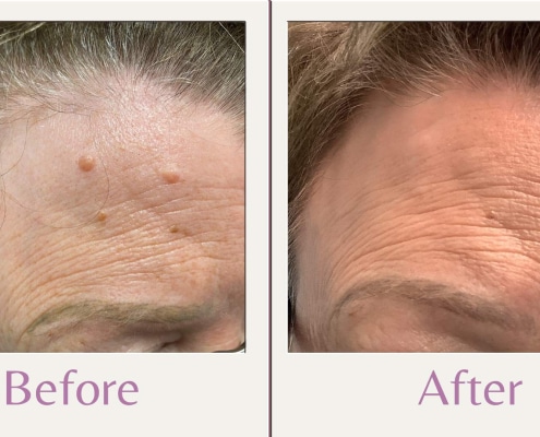 Shave moles on forehead