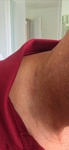 Skin cancer on neck after