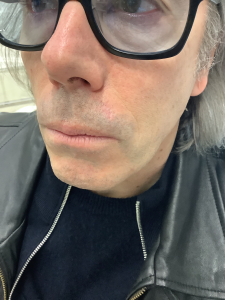 Skin cancer on top lip after