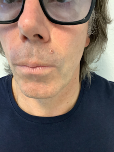 Skin cancer on top lip before